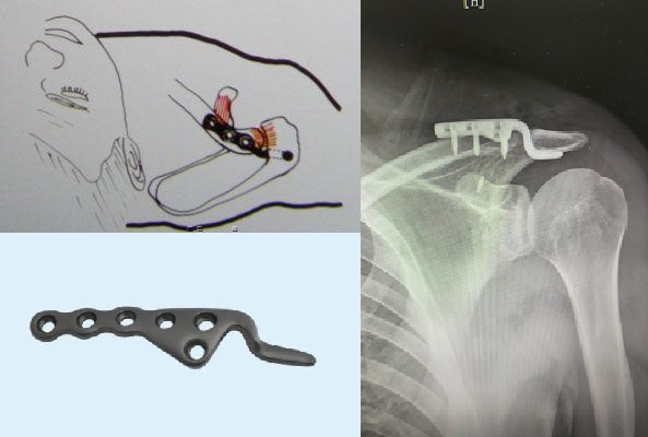 肩锁关节脱位治疗,肩锁关节脱位