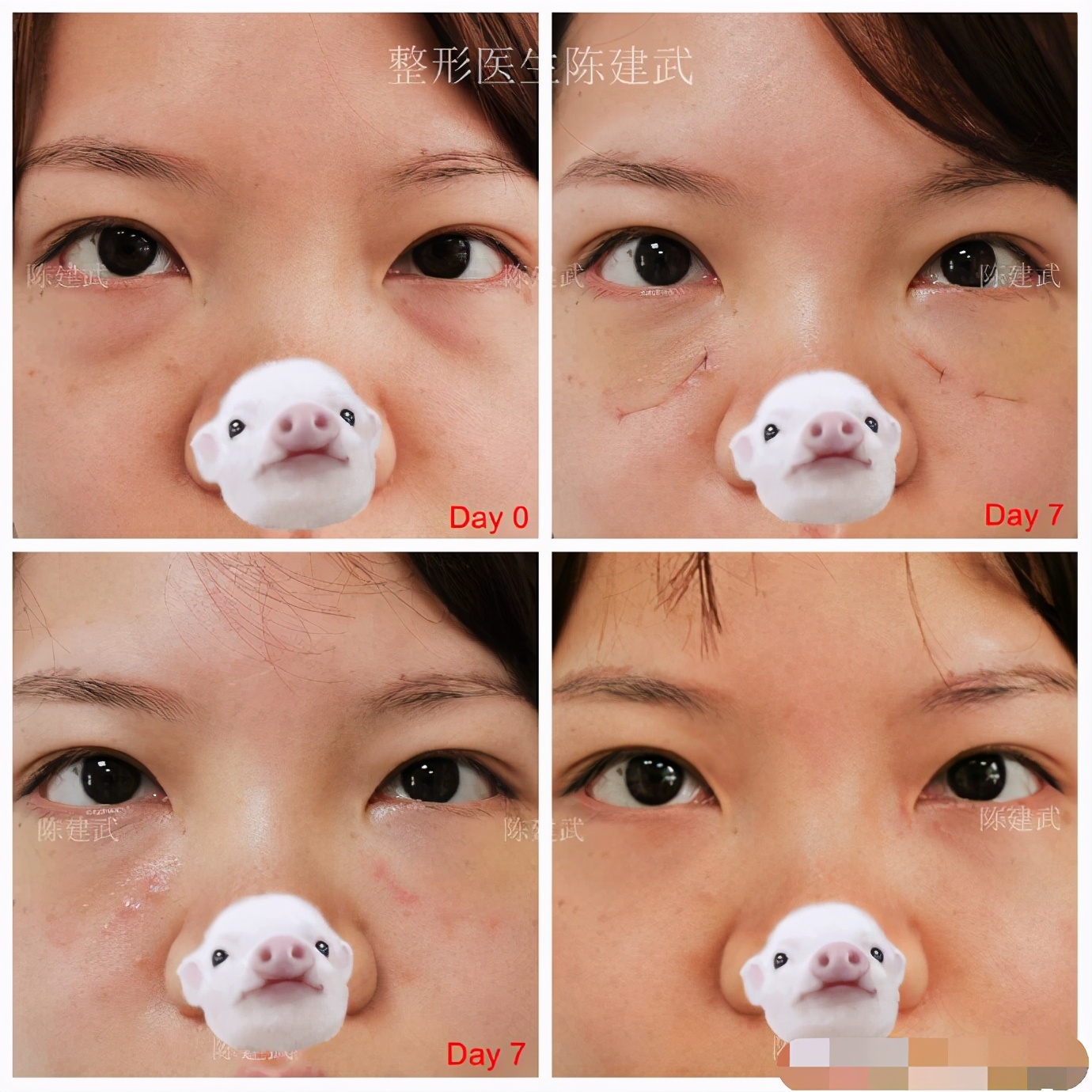 切眼袋后的疤痕增生多久能够恢复,为什么做了眼袋手术后悔的人很多