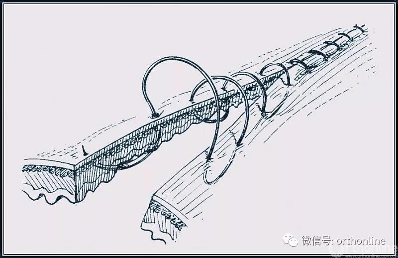 常用的手术缝合方法图,临床常见常用伤口缝合方法