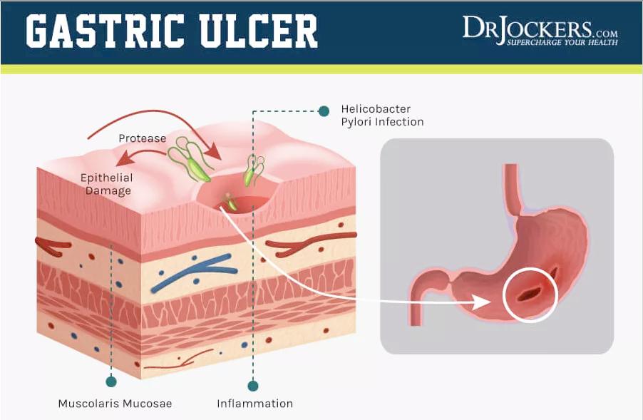导致口臭的原因有什么呢,口臭的原因一招解决