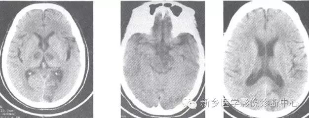 基底动脉尖综合征患者溶栓,基底动脉尖综合征名词解释