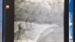 突发心脏骤停抢救措施总结会,心脏搭桥的血管闭塞怎么办