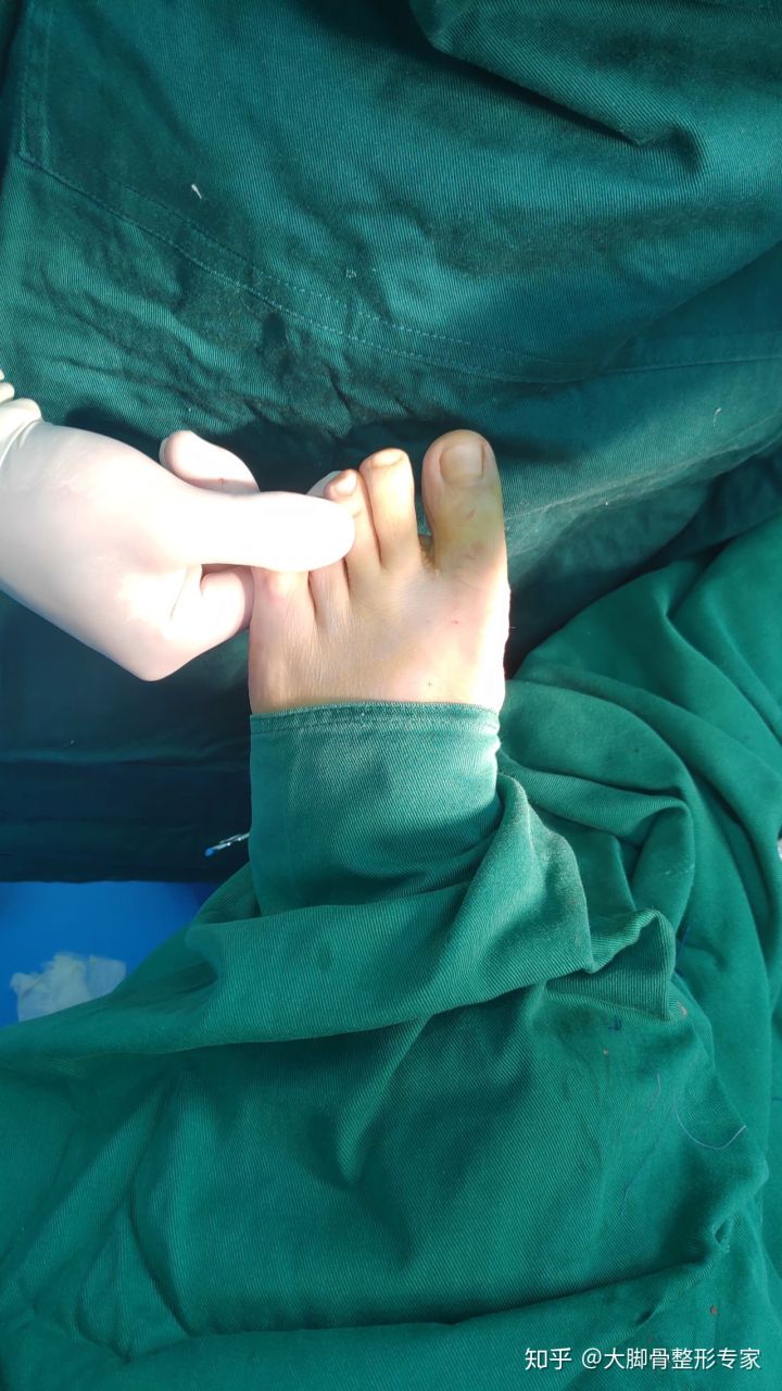 大脚骨判断标准,大脚骨自测方法