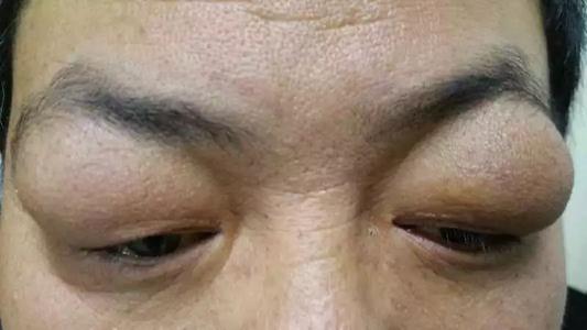 下眼睑黑眼圈特别严重是怎么回事,黑眼圈严重眼袋浮肿是什么原因