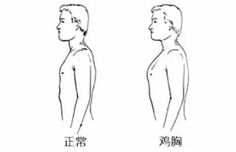 轻度的鸡胸和漏斗胸如何治疗,轻度鸡胸需要治疗吗