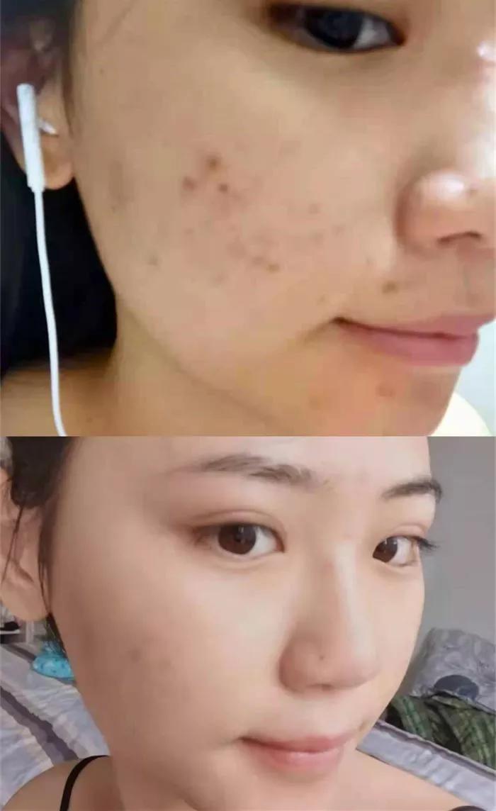 去皮肤科医院看痘痘,北京看痘痘好的皮肤科医院