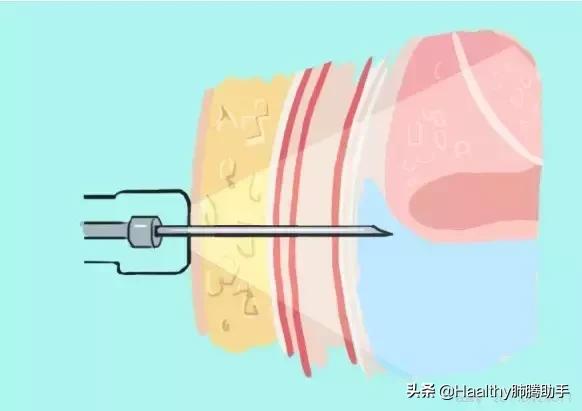 肺癌喘不过气来吃什么中药能缓解,肺癌喘不上气来怎么缓解