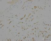 菁讲:你所不知道的横纹肌肉瘤