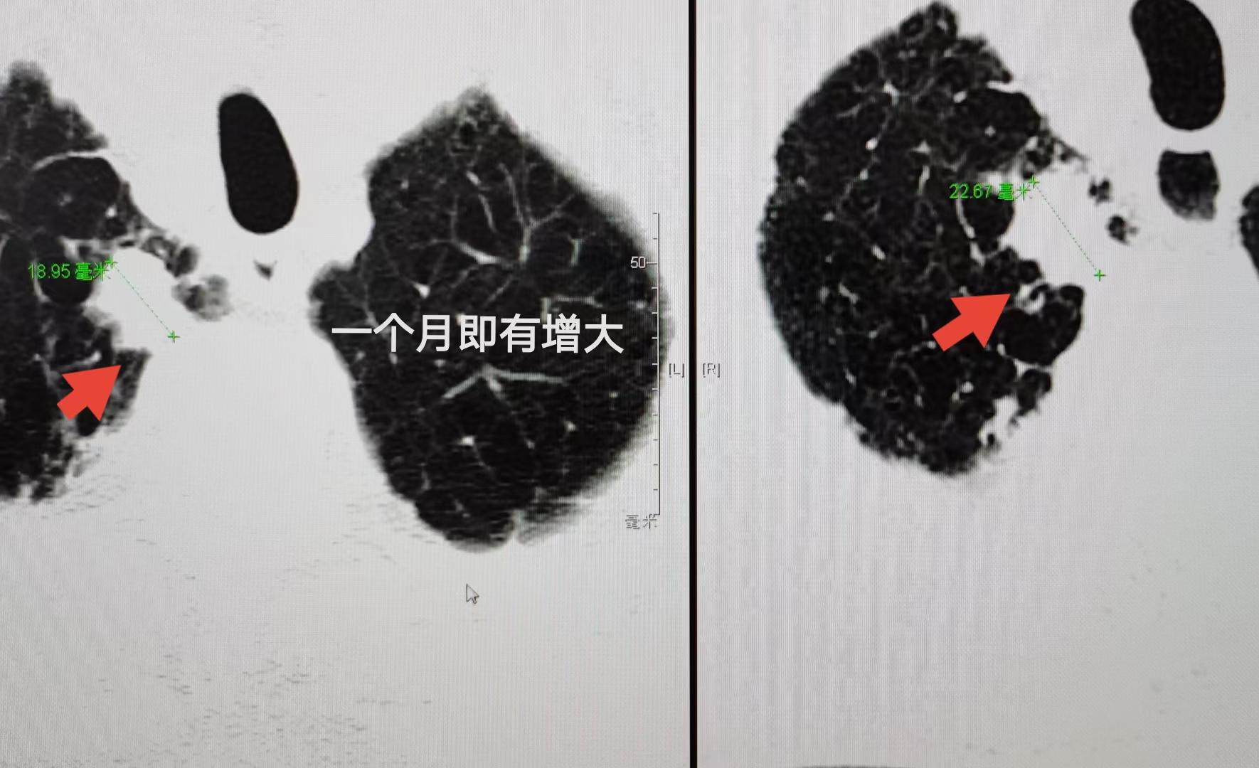 肺结节抗肿瘤治疗,肺结节诊治实例