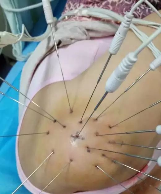 巨刺与缪刺疗法视频,巨刺与缪刺区别