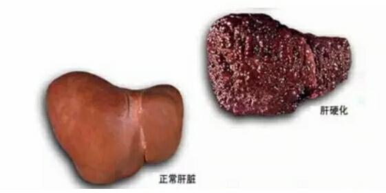 经方疏肝化瘀,疏肝解郁活血化瘀的药方有哪些