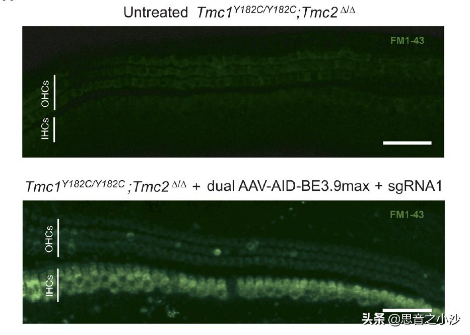 基因(DNA)编译,人类首次通过基因编辑攻克隐性遗传病