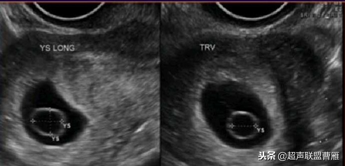 3毫米卵黄囊未见胎芽正常么,40多天的卵黄囊