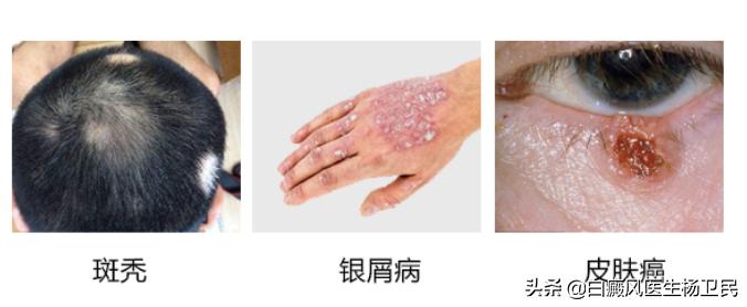 哪些误区阻挡你的白斑消除,白斑的真正可怕之处