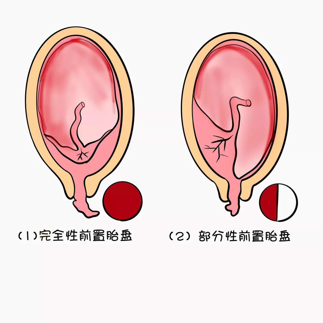 前置胎盘的护理诊断及措施,前置胎盘的护理诊断