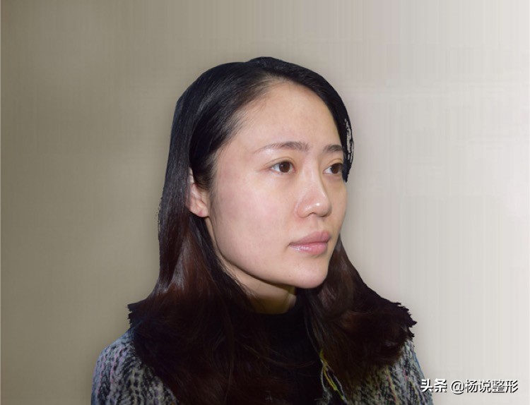 丑小鸭逆袭变天鹅,花3W做鼻整形值不值?术后200天恢复过程分享