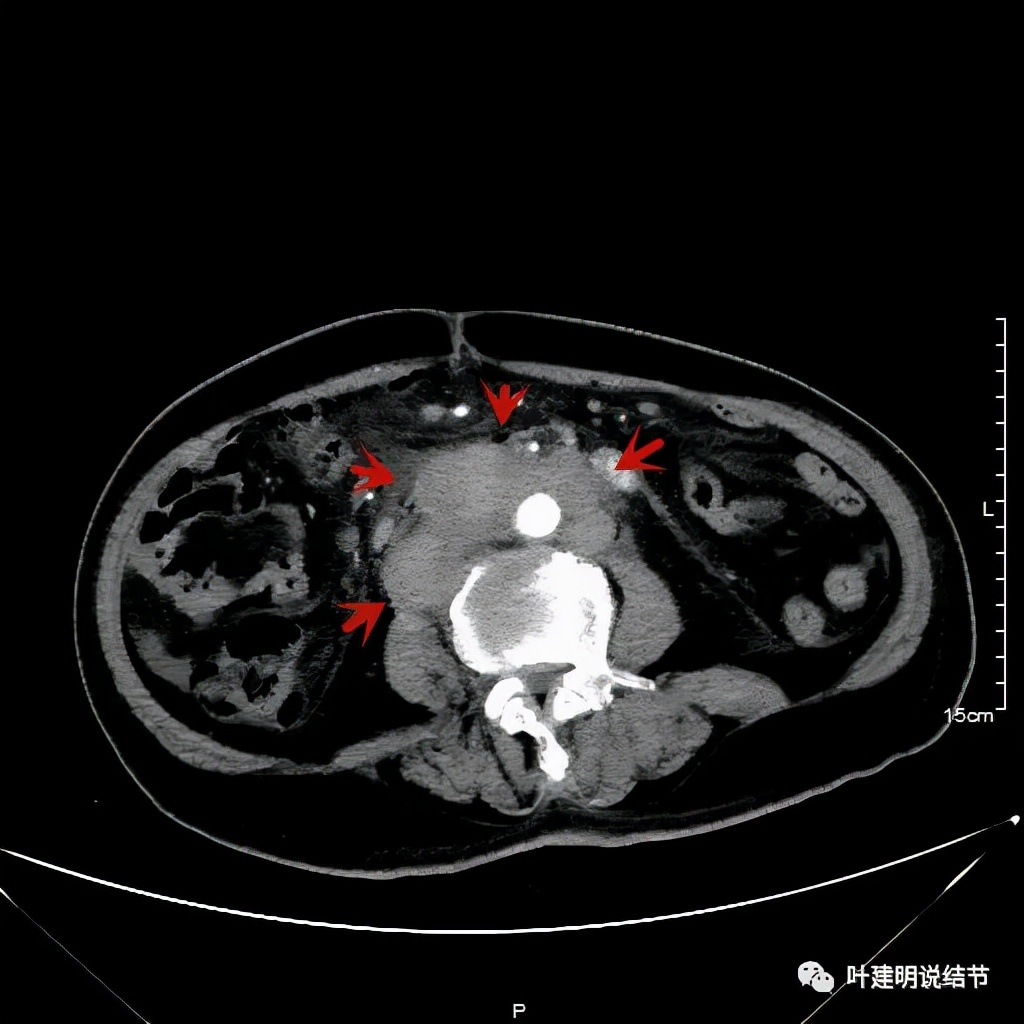 特瑞普利单抗食管癌成功案例,特瑞普利单抗治疗食管癌效果好吗