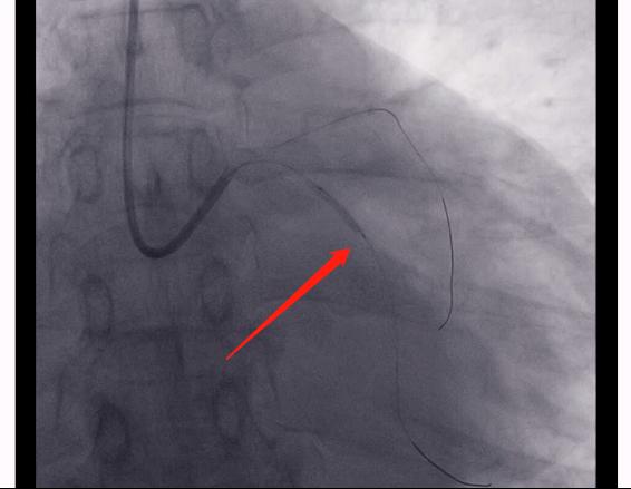 胸闷胸疼心脏彩超心电图ct没问题,胸疼但是心电图正常