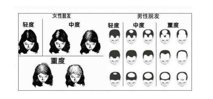 如何才能解决油脂性脱发,脱发地中海应该怎么治疗