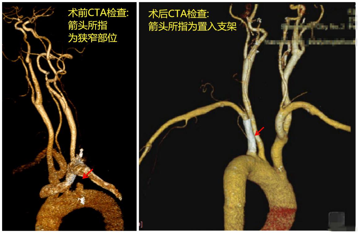 左锁骨下动脉闭塞会引起高血压吗,锁骨下动脉狭窄血压高还是低