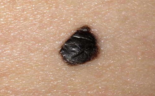 黑痣和黑痣区别图片,黑痣与一般痣癌变的概率