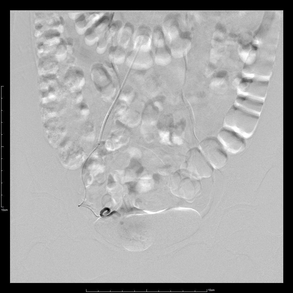囊性子宫腺肌病的特点是什么,囊性腺肌病最佳治疗方案