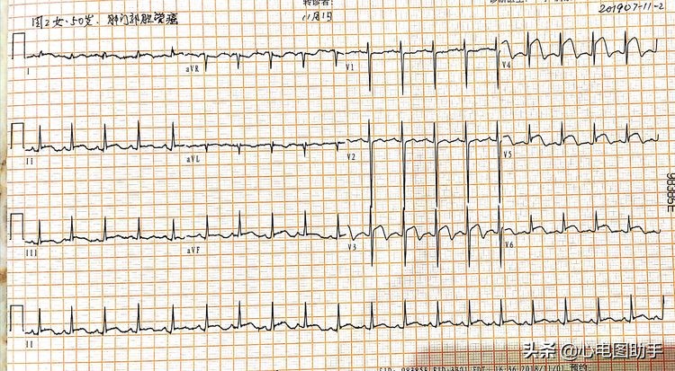 心脏肿瘤转移了还能手术吗,心脏肿瘤转移到肺