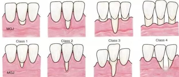 牙龈萎缩牙齿松动有办法补救吗？这个方法可以试一试