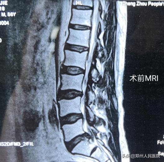 对骨科微创技术的认识,骨科手术与保守治疗对比
