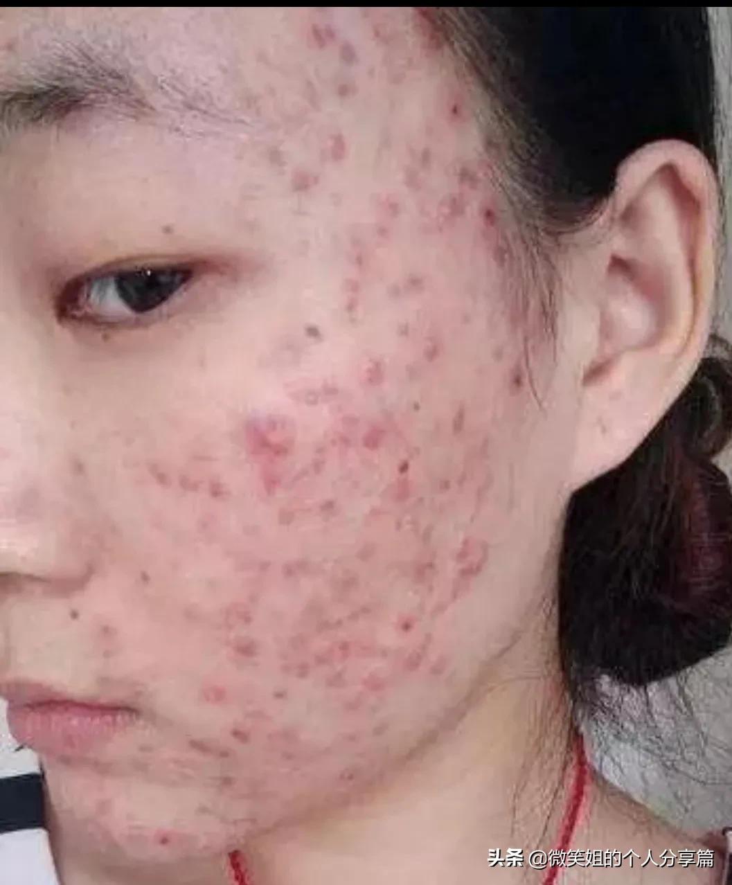 人中反复长痘,长闭口是怎么回事?