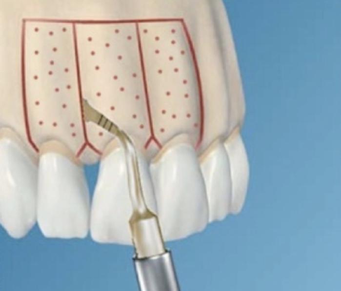 骨性地包天不做正颌手术最好方法,骨性地包天不做手术可矫正吗