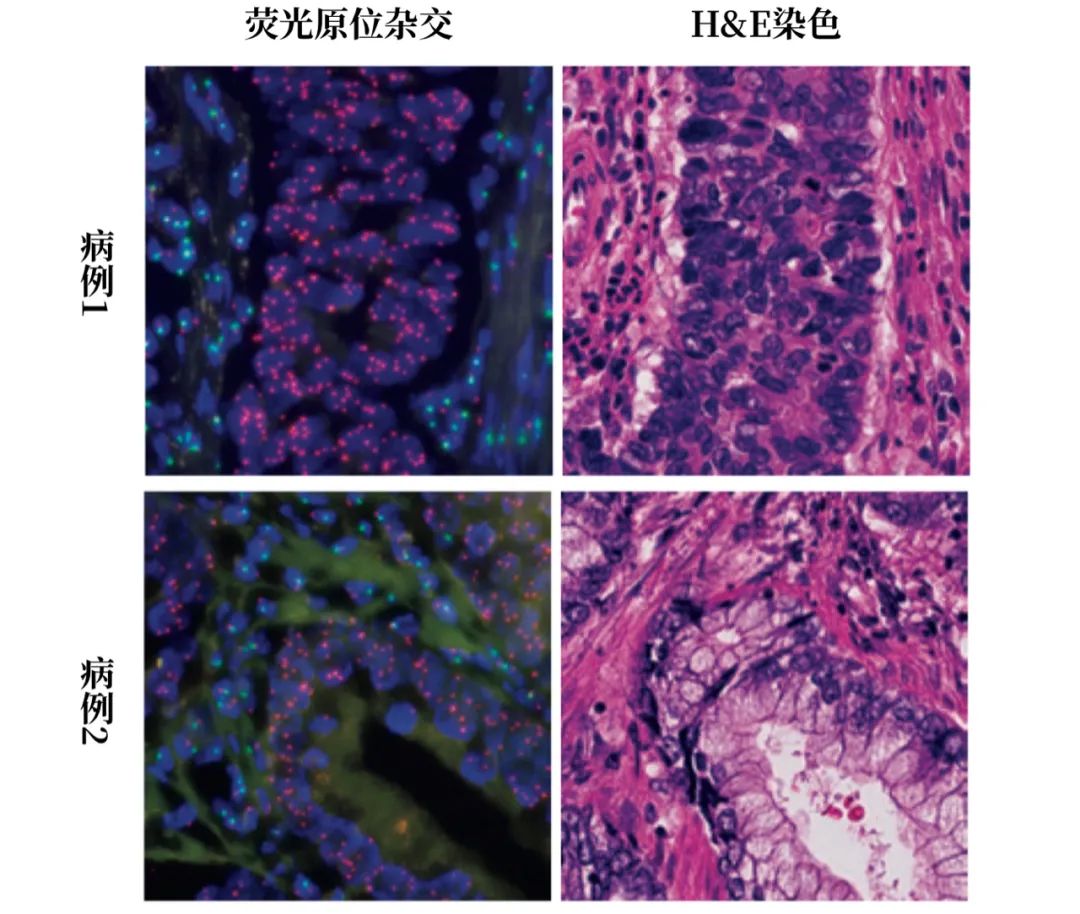 母亲顺产导致婴儿吸入癌细胞,2岁婴儿小细胞肺癌