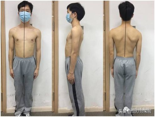 脑卒中后的平衡评价策略