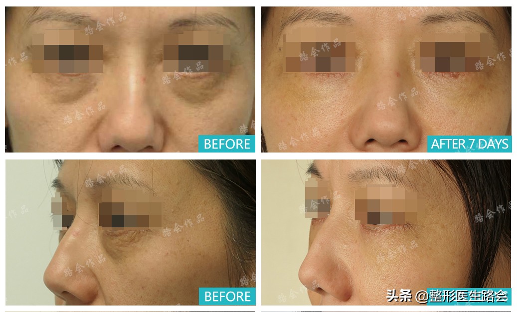 玻尿酸填泪沟为什么不吸收,玻尿酸填泪沟的好处和坏处