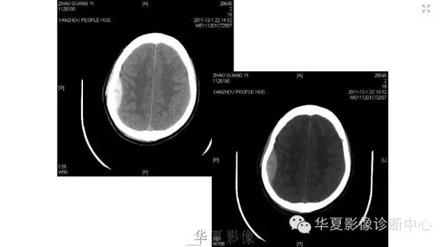 一文读懂颅内胆脂瘤,一文看懂背后的真相