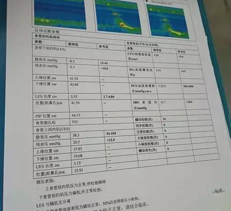 胃嗳气反酸能吃雷贝拉唑钠吗,打嗝胃胀吃雷贝拉唑有效果吗