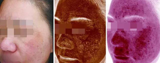 氨甲环酸对褐青斑有效果吗 (氨甲环酸去褐青斑吗)