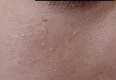 脂肪粒的形成原因以及消除方法,脂肪粒的形成原因以及去除方法