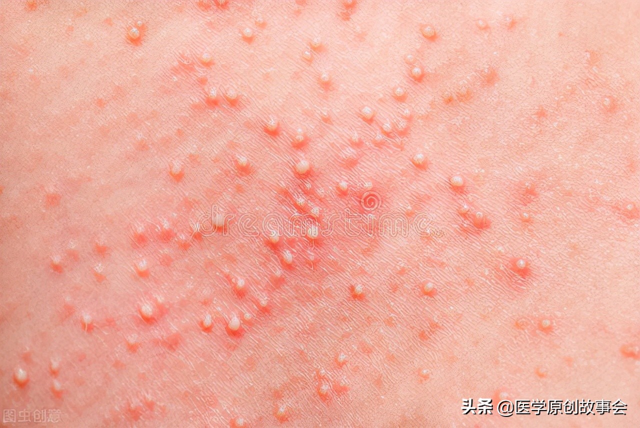 皮肤下挤出一个小肉球怎么处理,皮肤表面长出小肉球是什么原因呢