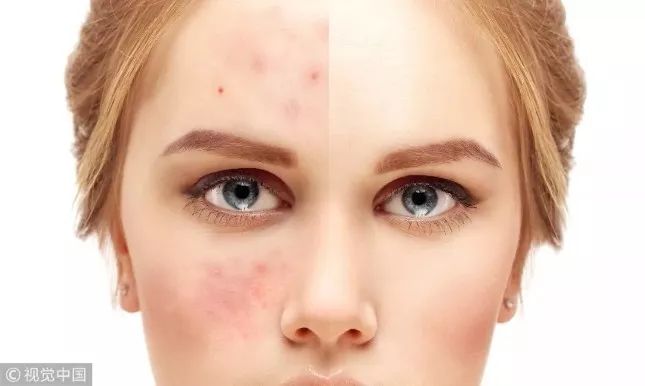 针对痘痘痘印的洗面奶,可以淡化痘印的洗面奶测评