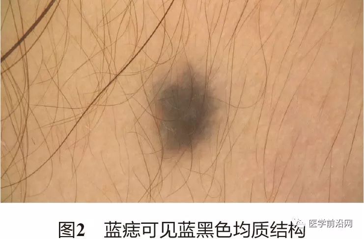 面部常见皮肤病皮肤镜诊断专家共识全文发布