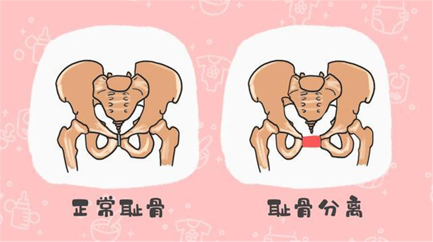 孕期“耻骨”痛到厌世？五类孕妇更易中招，缓解疼痛有妙招