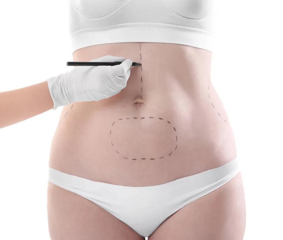 吸脂后出现淤青，应该如何应对？