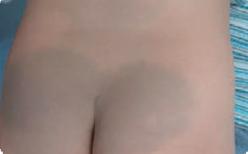 宝宝身上有不光滑胎记,宝宝身上胎记不哭就没有