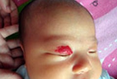 郴州市第一人民医院祛胎记,郴州第一人民医院治疗肝脏血管瘤