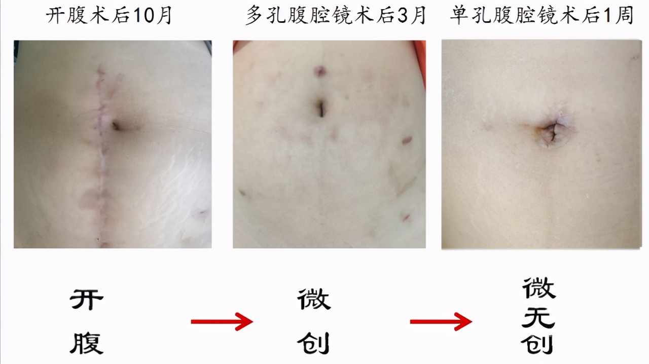 宫外孕微创手术的伤疤要涂什么药,宫外孕手术会不会留下伤疤