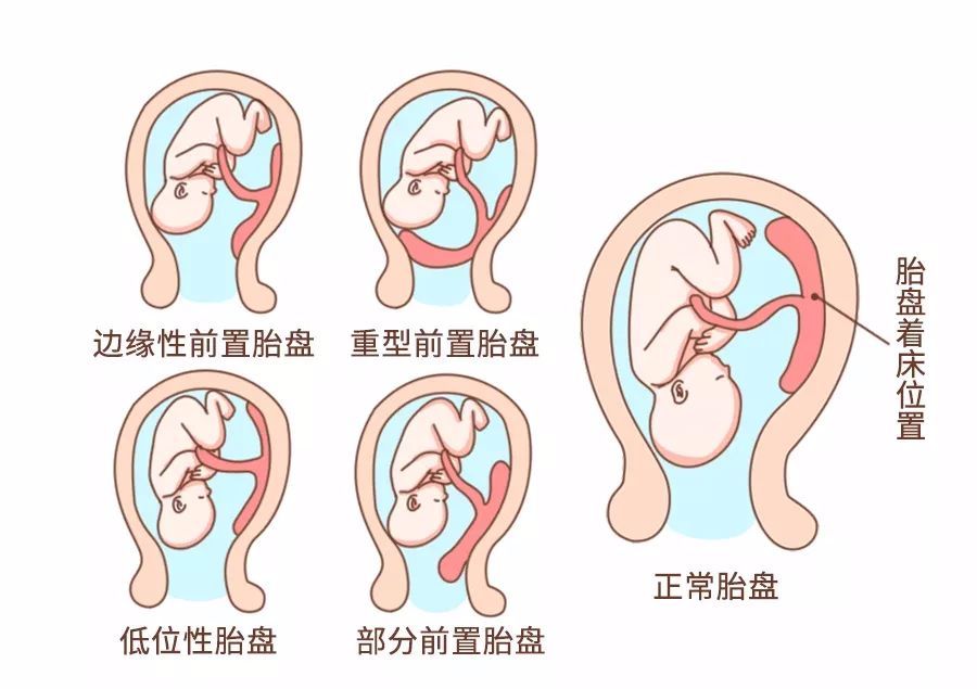 顺产为什么要转为剖宫产,顺产还是剖腹产容易清宫