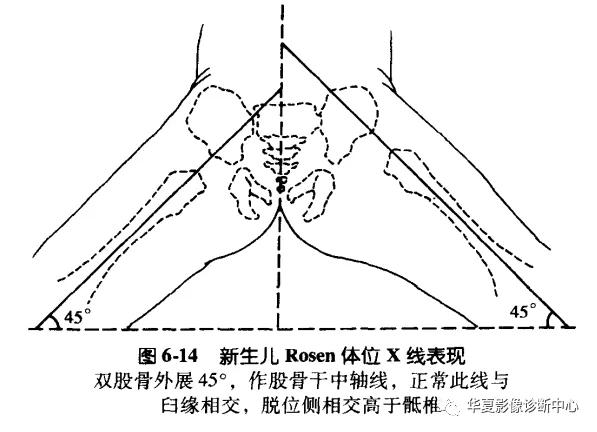 先天性髋关节脱位,先天性髋关节脱位属不属于残疾人