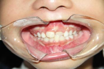 8岁的孩子能做牙齿矫正吗,7岁孩子矫正牙齿早吗