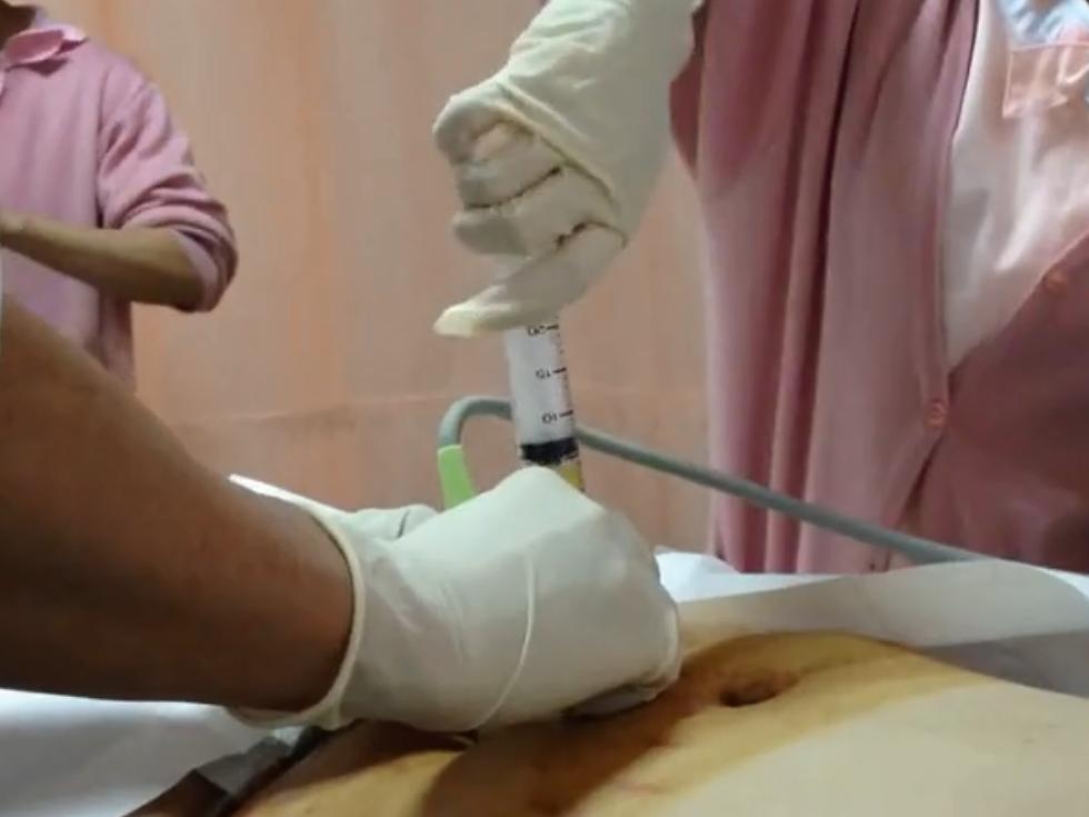 让孕妈颤抖的羊水穿刺,到底是怎么做的?光看图片都觉得疼